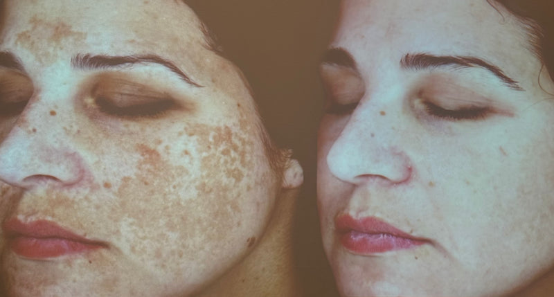 Cosmelan Professional Treatment (Mandatory In Spa Appointments Required)once purchased please call us to schedule your appointment in LA or Miami