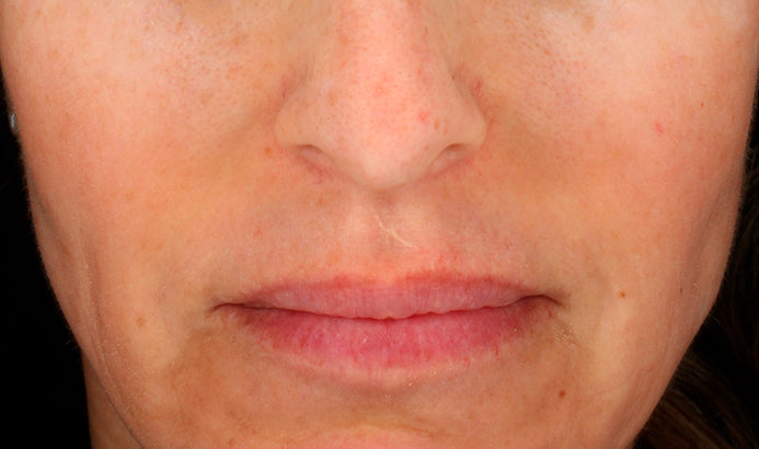 Cosmelan Professional Treatment (Mandatory In Spa Appointments Required)once purchased please call us to schedule your appointment in LA or Miami