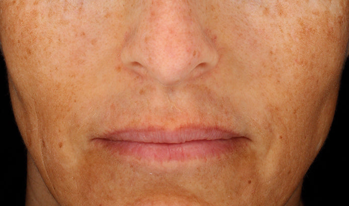 Cosmelan Professional Treatment (Mandatory In Spa Appointments Required)once purchased please call us to schedule your appointment in LA or Miami