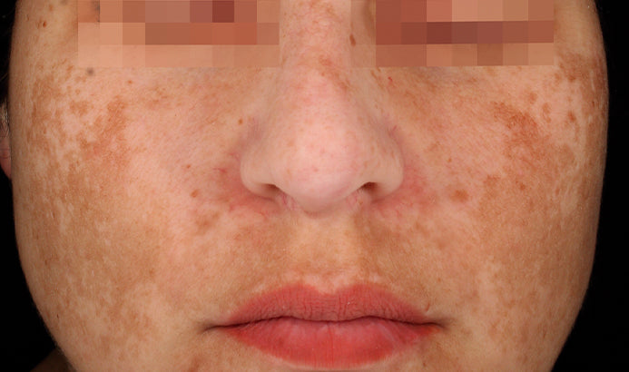 Cosmelan Professional Treatment (Mandatory In Spa Appointments Required)once purchased please call us to schedule your appointment in LA or Miami