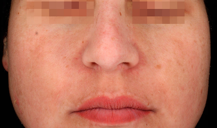 Cosmelan Professional Treatment (Mandatory In Spa Appointments Required)once purchased please call us to schedule your appointment in LA or Miami