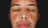 Cosmelan Professional Treatment (Mandatory In Spa Appointments Required)once purchased please call us to schedule your appointment in LA or Miami