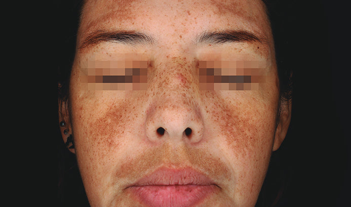 Cosmelan Professional Treatment (Mandatory In Spa Appointments Required)once purchased please call us to schedule your appointment in LA or Miami