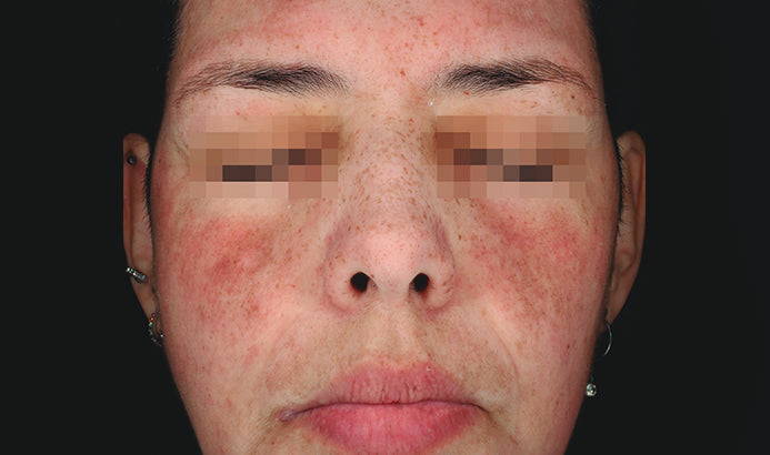 Cosmelan Professional Treatment (Mandatory In Spa Appointments Required)once purchased please call us to schedule your appointment in LA or Miami